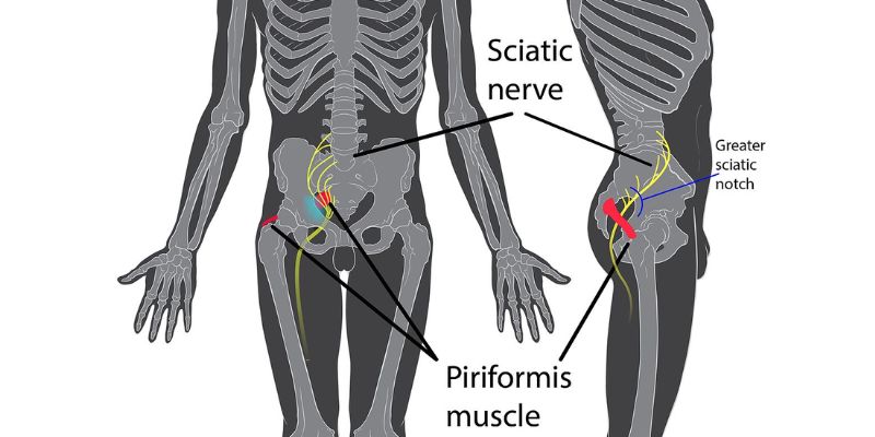 What Are The Types Of Nerve Compression Syndrome?